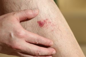 A Complete Guide To Using Antibiotics For Skin Infections